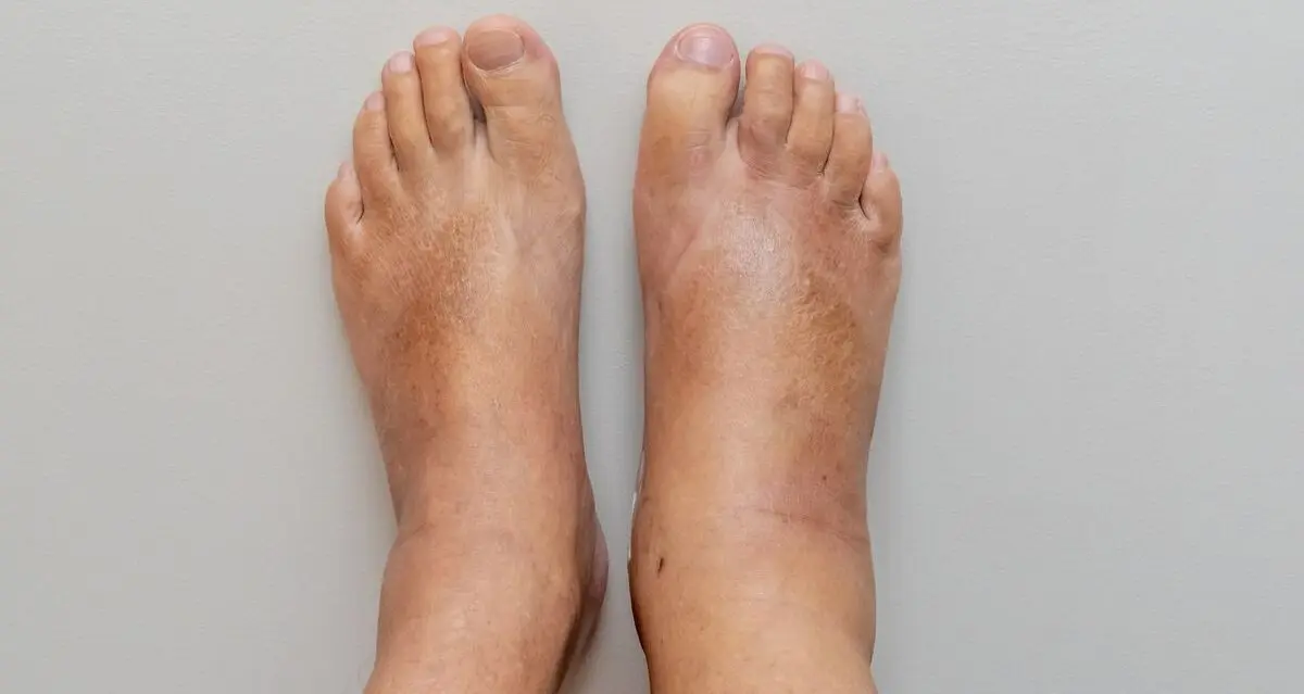 foot-edema-e1668067517187