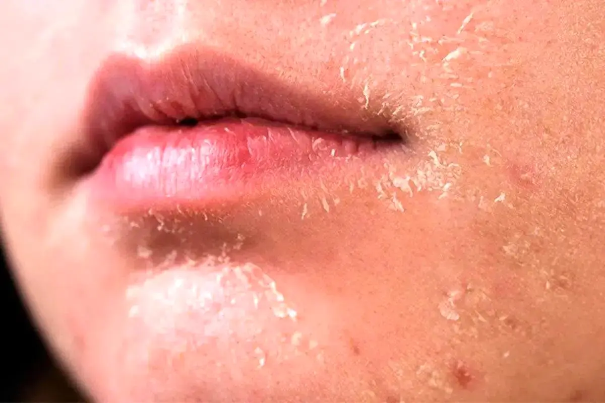 ۵ روش برای مراقبت از پوست در زمستان | با این چند روش ساده پوست براق و لطیف داشته باشید
