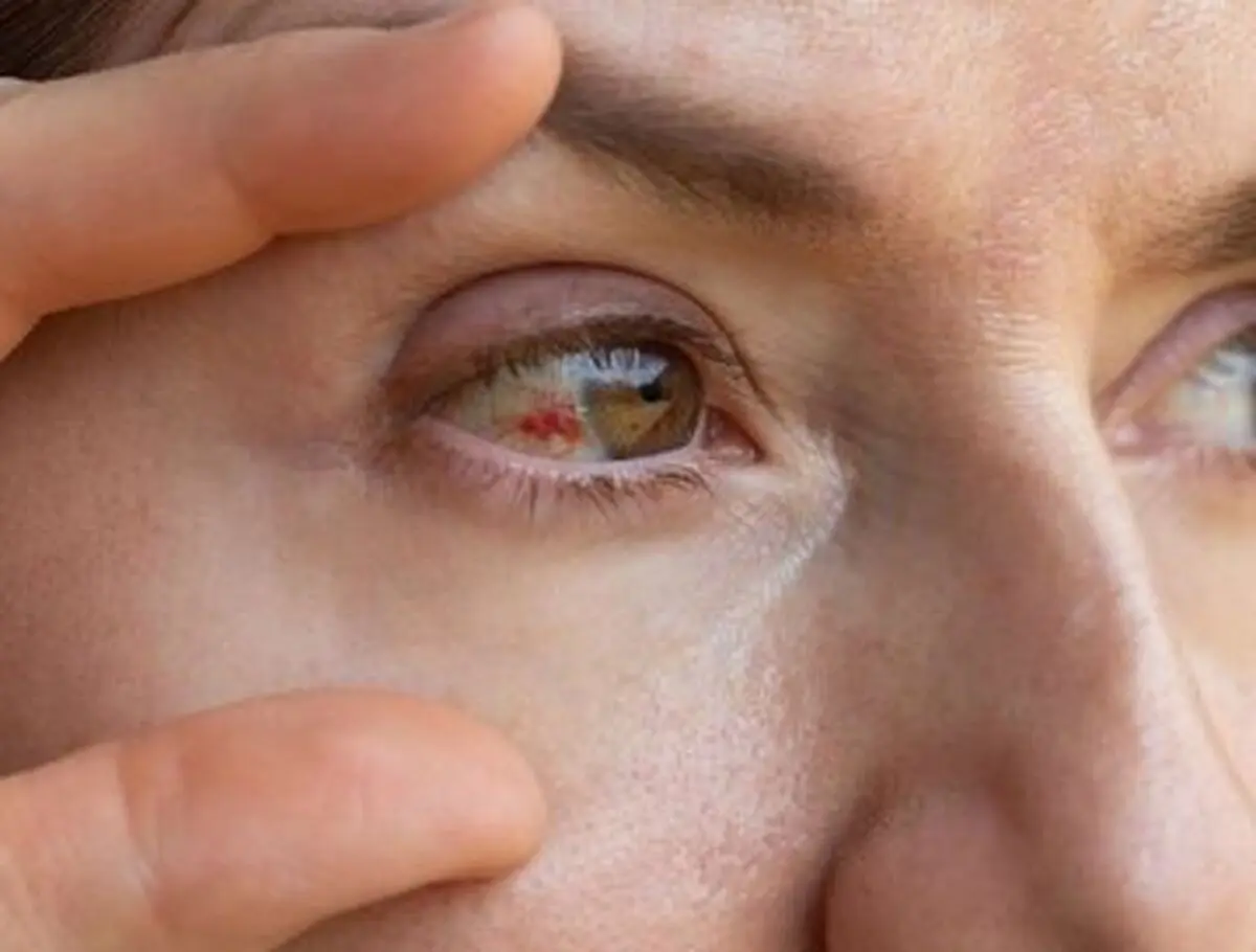 دلایل پارگی رگ خونی در چشم | چه موقع باید به پزشک مراجعه کنیم؟