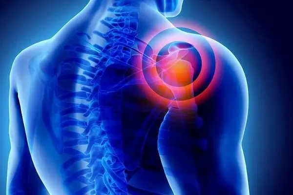 آیا سرما باعث درد شانه می‌شود؟