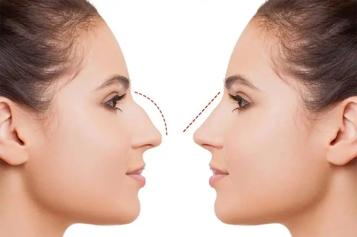 بهترین جراحی بینی در ایلام؛ انتخابی مهم برای زیبایی بیشتر