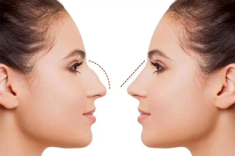 بهترین جراحی بینی در ایلام؛ انتخابی مهم برای زیبایی بیشتر