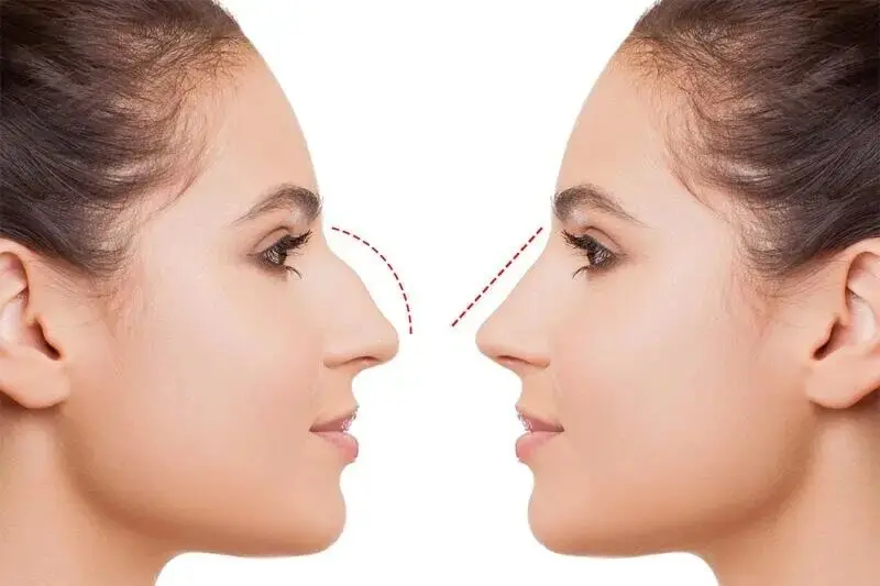 بهترین جراحی بینی در ایلام؛ انتخابی مهم برای زیبایی بیشتر