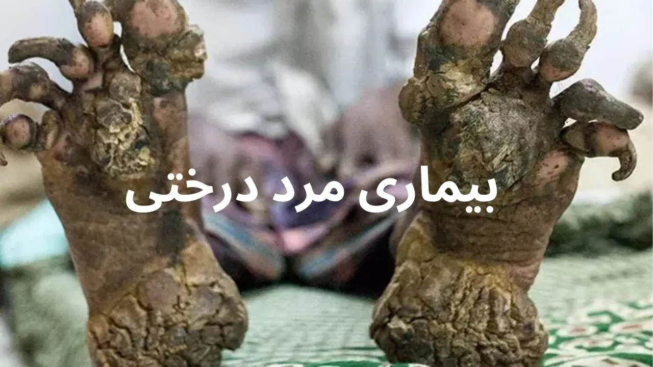بیماری مرد درختی چیست و عبدالنصیر، مرد درختی ایران کیست؟