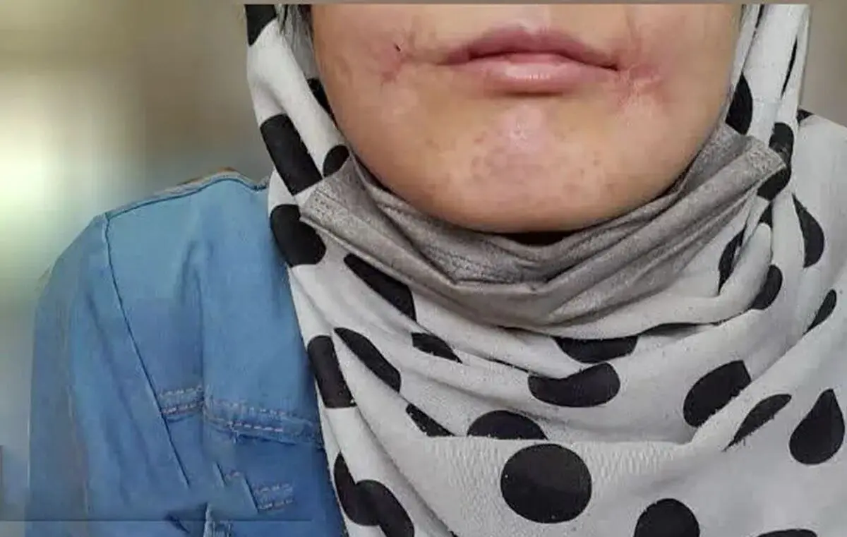 مرد مشهدی لب‌های زن ۱۸ ساله‌اش را دوخت | فائزه به کلانتری پناه برد + عکس
