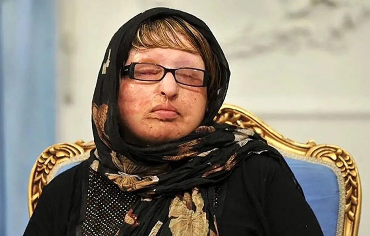 ماجرای تکان‌دهنده اسیدپاشی به آمنه بهرامی؛ از فاجعه تا بخشش از زبان خودش