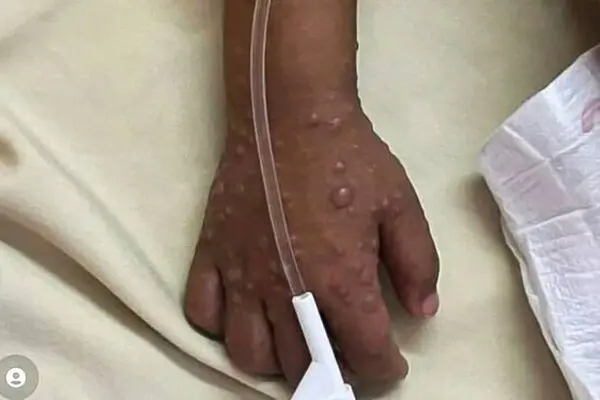 فوری،۵۰۰ درصد،موارد آبله میمون در آفریقا افزایش یافت
