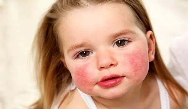 علت ایجاد آلرژی یا حساسیت غذایی در کودکان چیست؟
