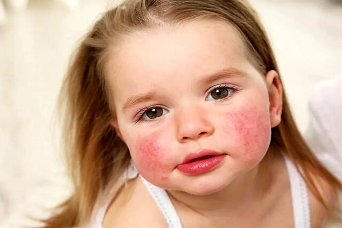 علت ایجاد آلرژی یا حساسیت غذایی در کودکان چیست؟
