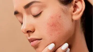 نشانه‌های کلسترول بالا روی پوست را بشناسید