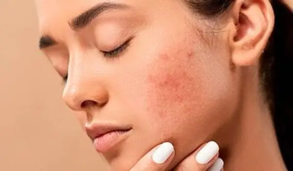 نشانه‌های کلسترول بالا روی پوست را بشناسید