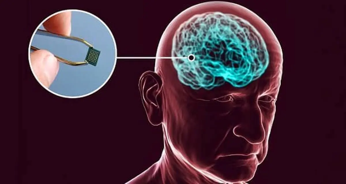 اولین ایمپلنت مغزی تجاری جهان  | رقیب جدی نورالینکِ ایلان ماسک