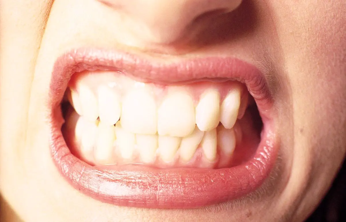 رعب آورترین عوارض تراکم و فشردگی دندان‌ها به یکدیگر