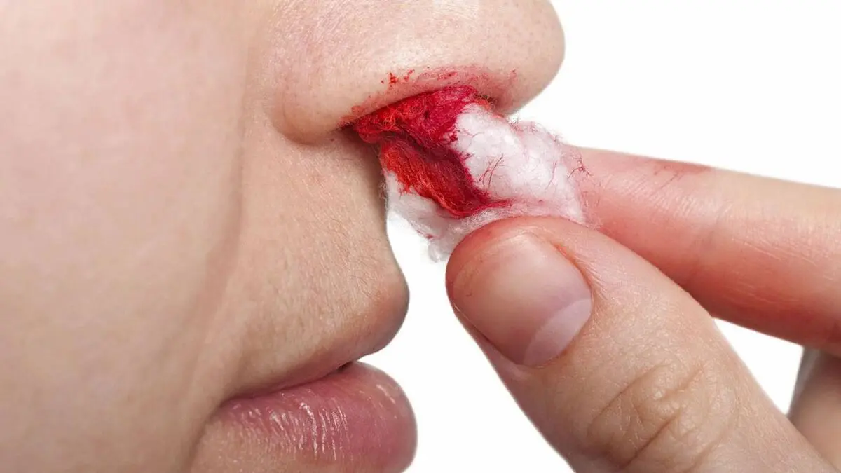 هنگام خونریزی بینی سر خود را بالا نگیرید