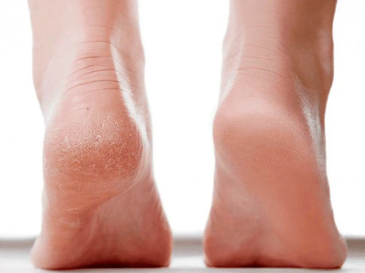 ۶ توصیه مهم برای سلامت پاها