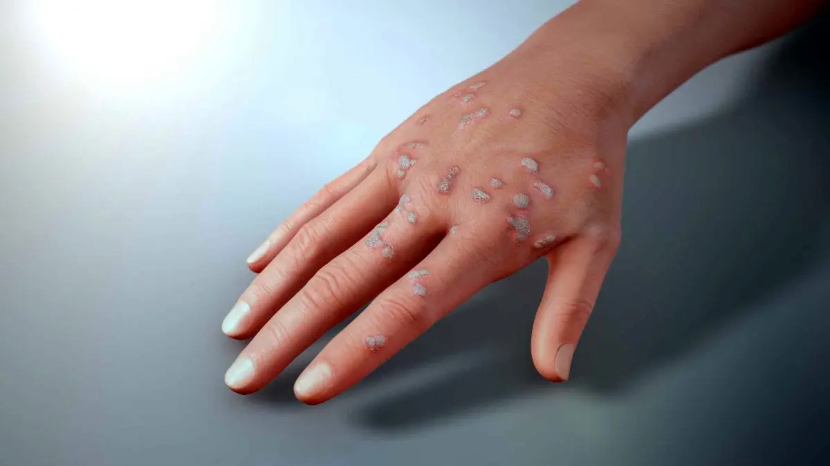 «زگیل» را چطور درمان کنیم؟