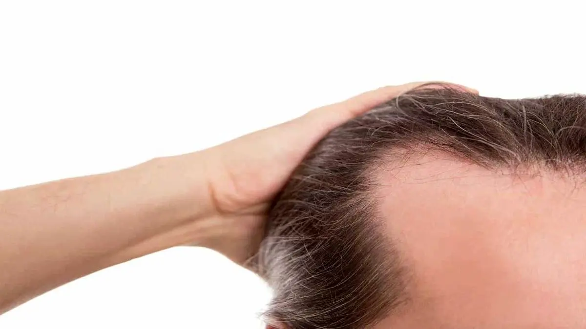 ارتباط نوشیدنی های شیرین با ریزش مو در مردان