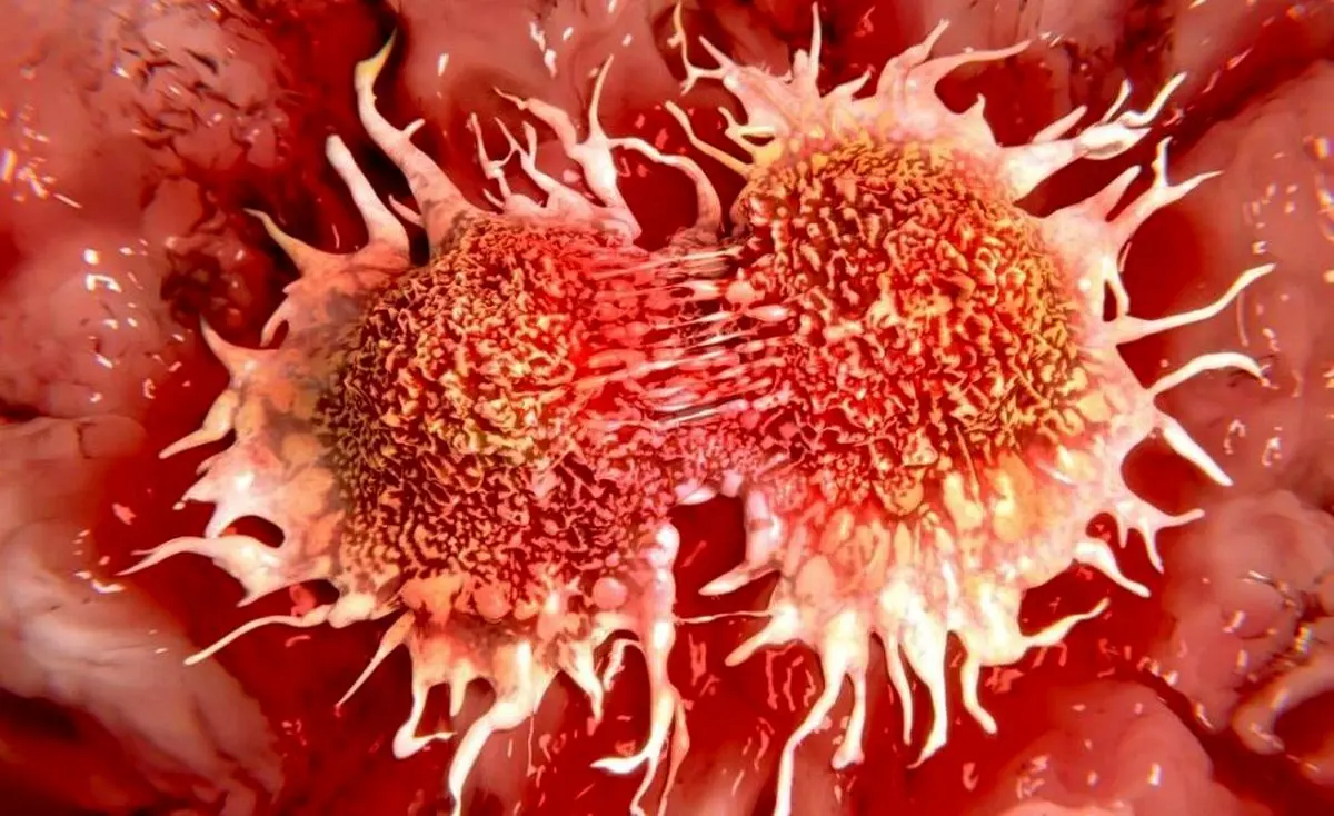 سرطان روده چه نوع سرطانی است؟