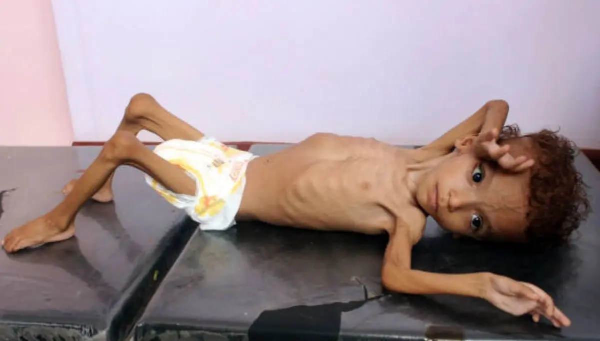 سوء تغذیه شدید کودک یمنی + تصویر