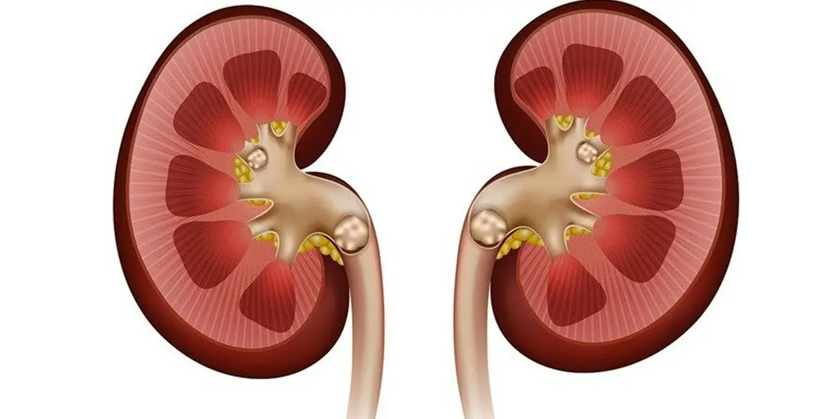 راه هایی برای پیشگیری از سنگ کلیه