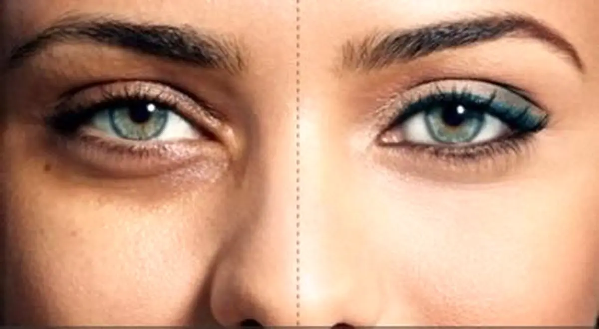 چرا زیر چشم سیاه می‌شود؟ | علت گودی زیر چشم و درمان آن
