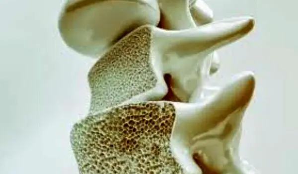 این علائم یعنی استخوان‌های شما پوک می‌شود!