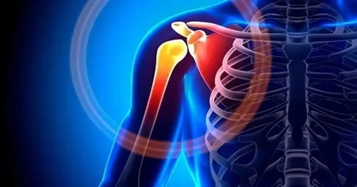 شانه یخ‌زده چیست؟ + درمان