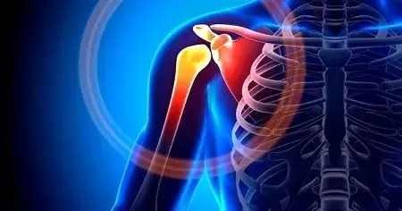 شانه یخ‌زده چیست؟ + درمان