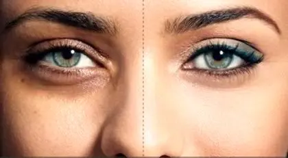 چرا زیر چشم سیاه می‌شود؟ | علت گودی زیر چشم و درمان آن