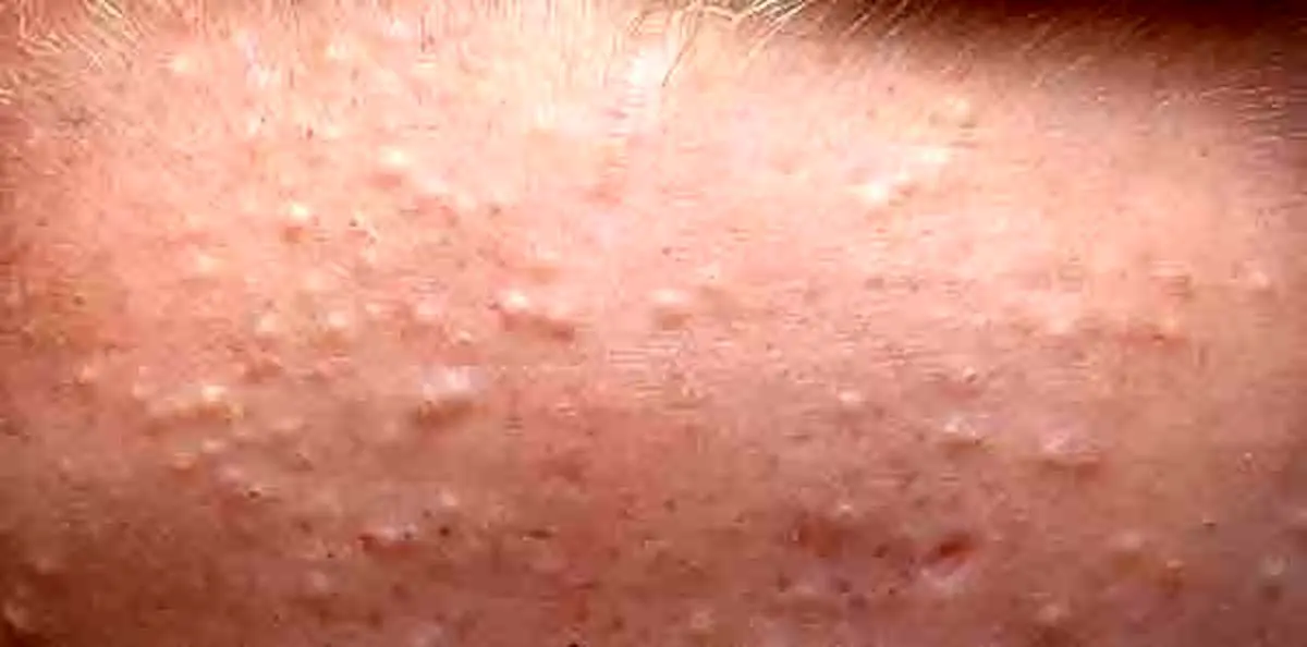 چگونه جوشهای زیر پوستی را درمان کنیم؟