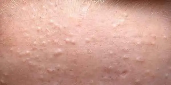 چگونه جوش‌های زیر پوستی را درمان کنیم؟