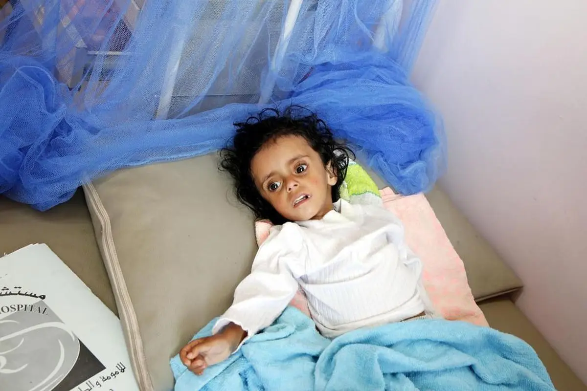 سوء تغذیه کودکان در یمن بیداد می کند + تصویر