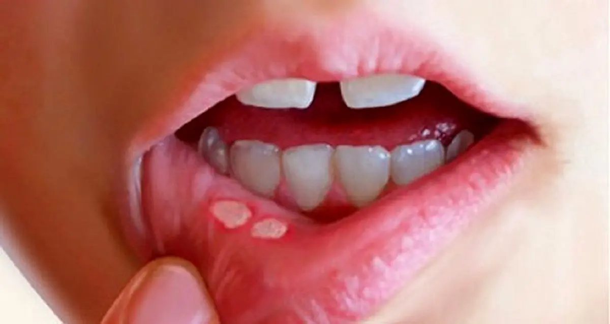 مراقب این زخم‌های خطرناک دهانی باشید | رسانه خبری اینتیتر | %