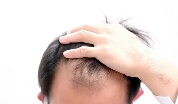 دلایل شایع ریزش مو