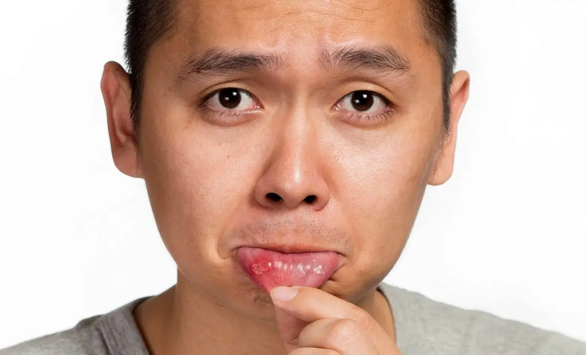 آفت دهانی که علامت سرطان دارد !