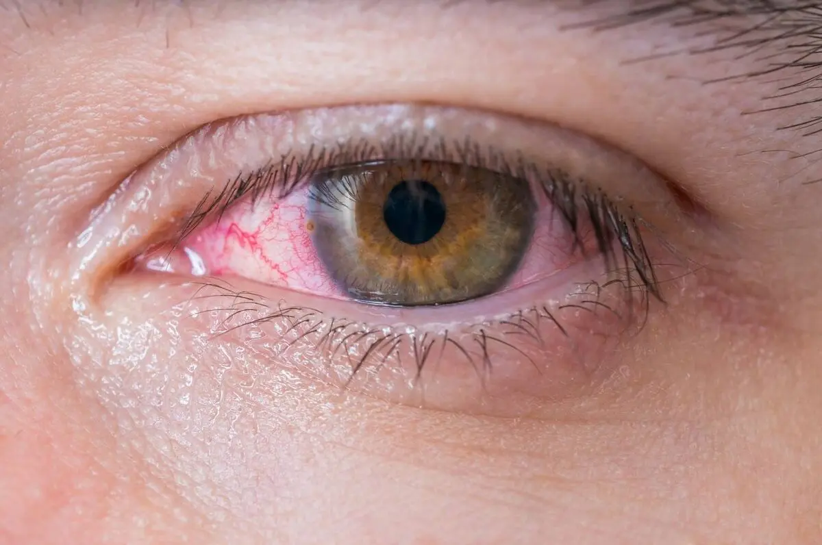 عارضه «چشم صورتی» علامت بیماری کرونا است | رسانه خبری اینتیتر |