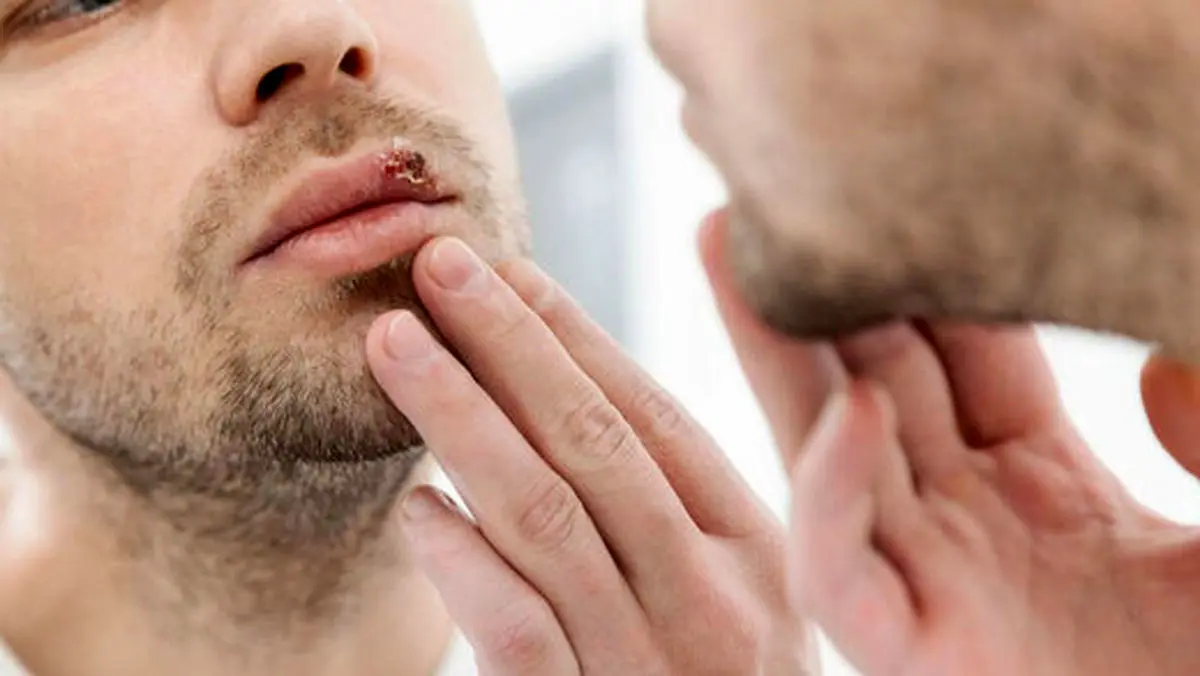 آیا آفت و تبخال با استرس تشدید می‌شوند؟