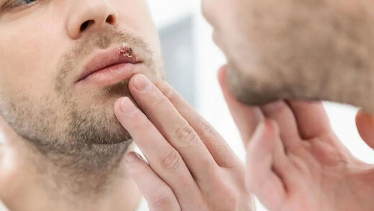آیا آفت و تبخال با استرس تشدید می‌شوند؟