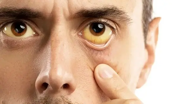 ۵ علامت هشداردهنده کبد چرب روی صورت
