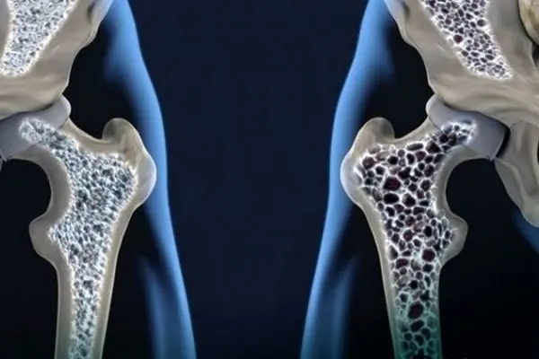 با مصرف این ویتامین‌ها استخوان‌های خود را تقویت کنید
