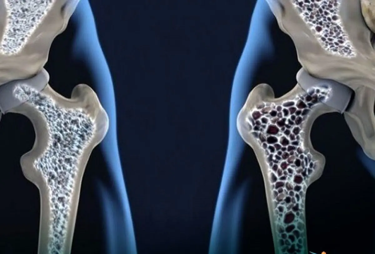 با مصرف این ویتامین‌ها استخوان‌های خود را تقویت کنید
