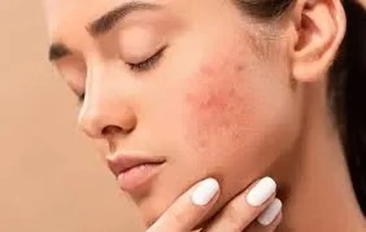 ۱۱ روش برای از بین بردن جای جوش روی پوست
