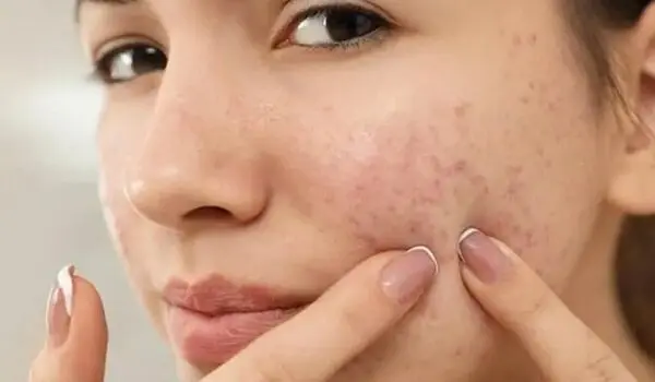 آیا جوش صورت نشانه بالا بودن تستوسترون است؟