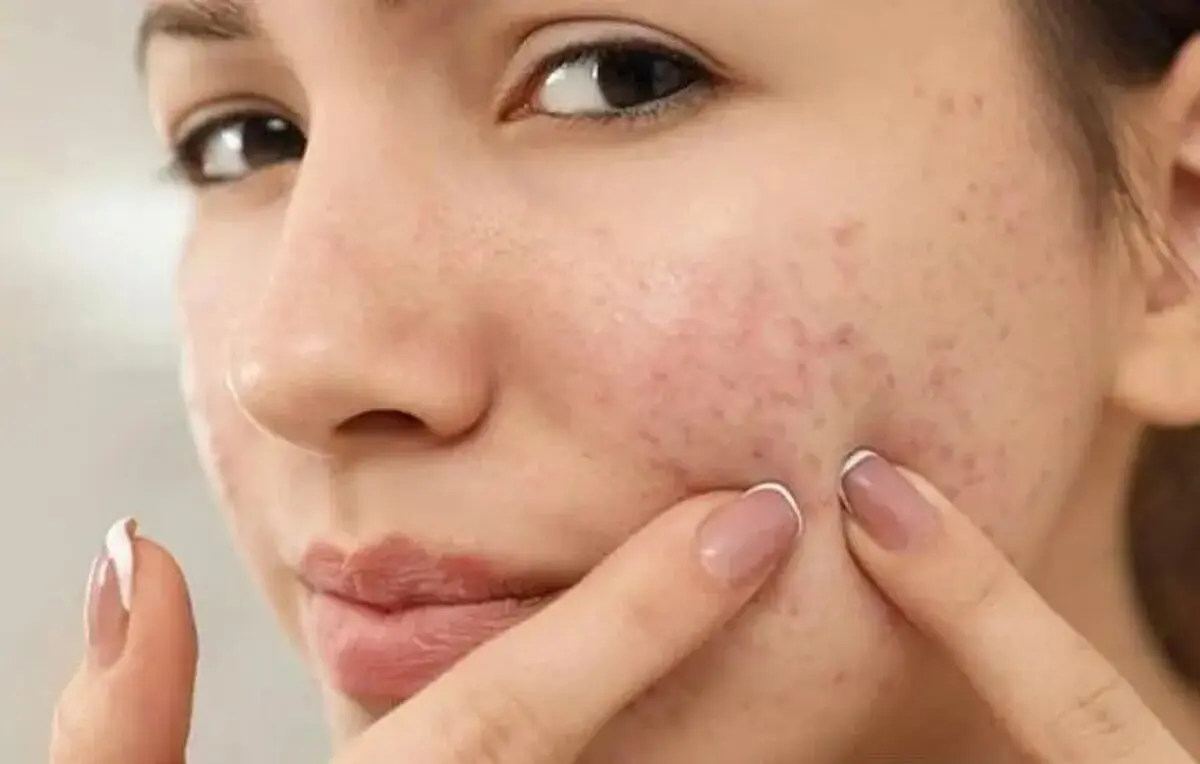 آیا جوش صورت نشانه بالا بودن تستوسترون است؟