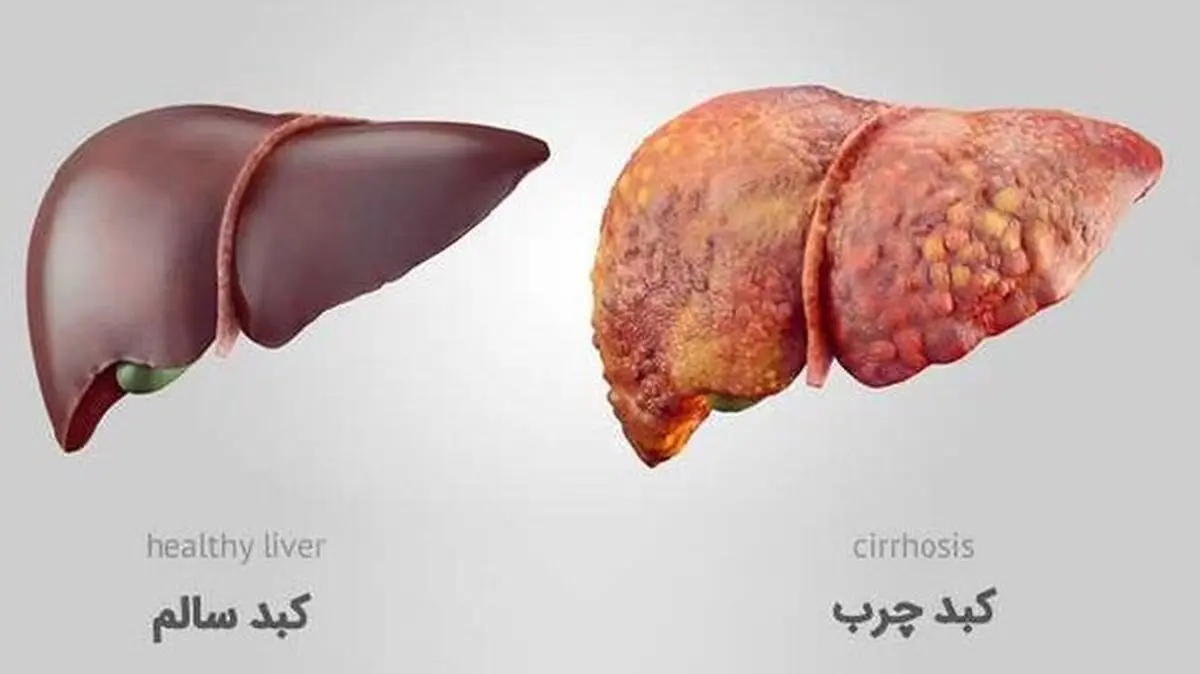 ویتامین کبد چیست؟ | ۵ ویتامین برای سلامتی کبد