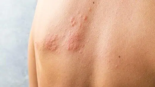 دردناک‌ترین بیماری محتمل بهاری! | چرا در این فصل شیوع بیماری بیشتر است؟