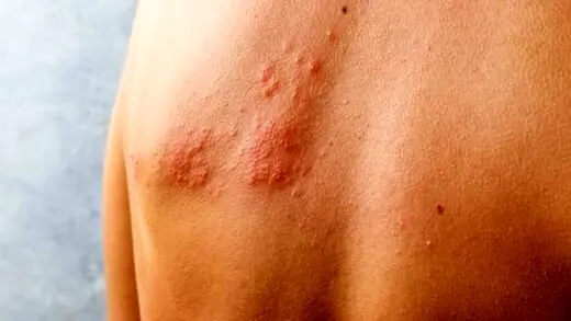 دردناک‌ترین بیماری محتمل بهاری! | چرا در این فصل شیوع بیماری بیشتر است؟
