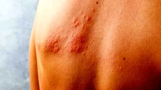 دردناک‌ترین بیماری محتمل بهاری! | چرا در این فصل شیوع بیماری بیشتر است؟