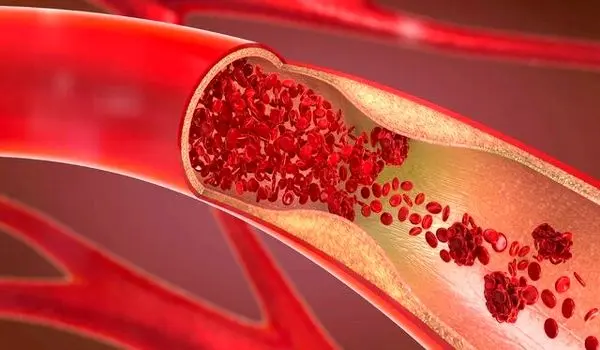 روش‌های اورژانسی پیشگیری از خونریزی در مجروحان
