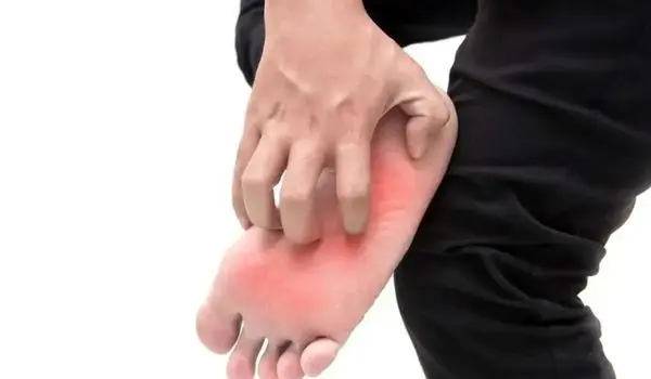 خارش کف پا؛ مشکل کوچک یا نشانه بیماری جدی؟
